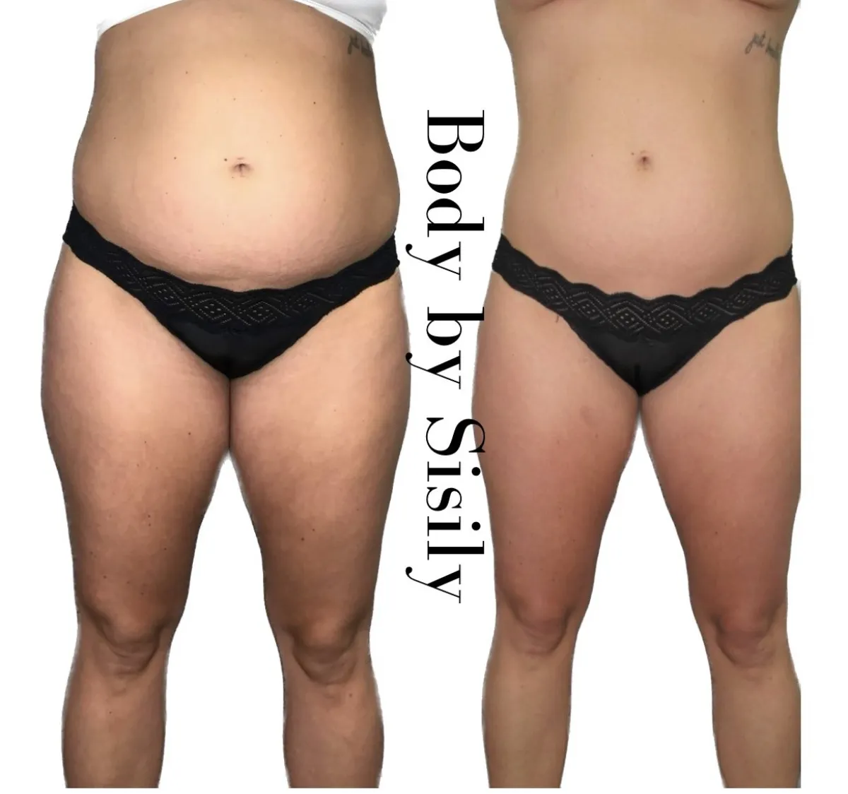 Side-by-side of a woman's thighs and hips before and after treatment, showing a smoother outer thigh