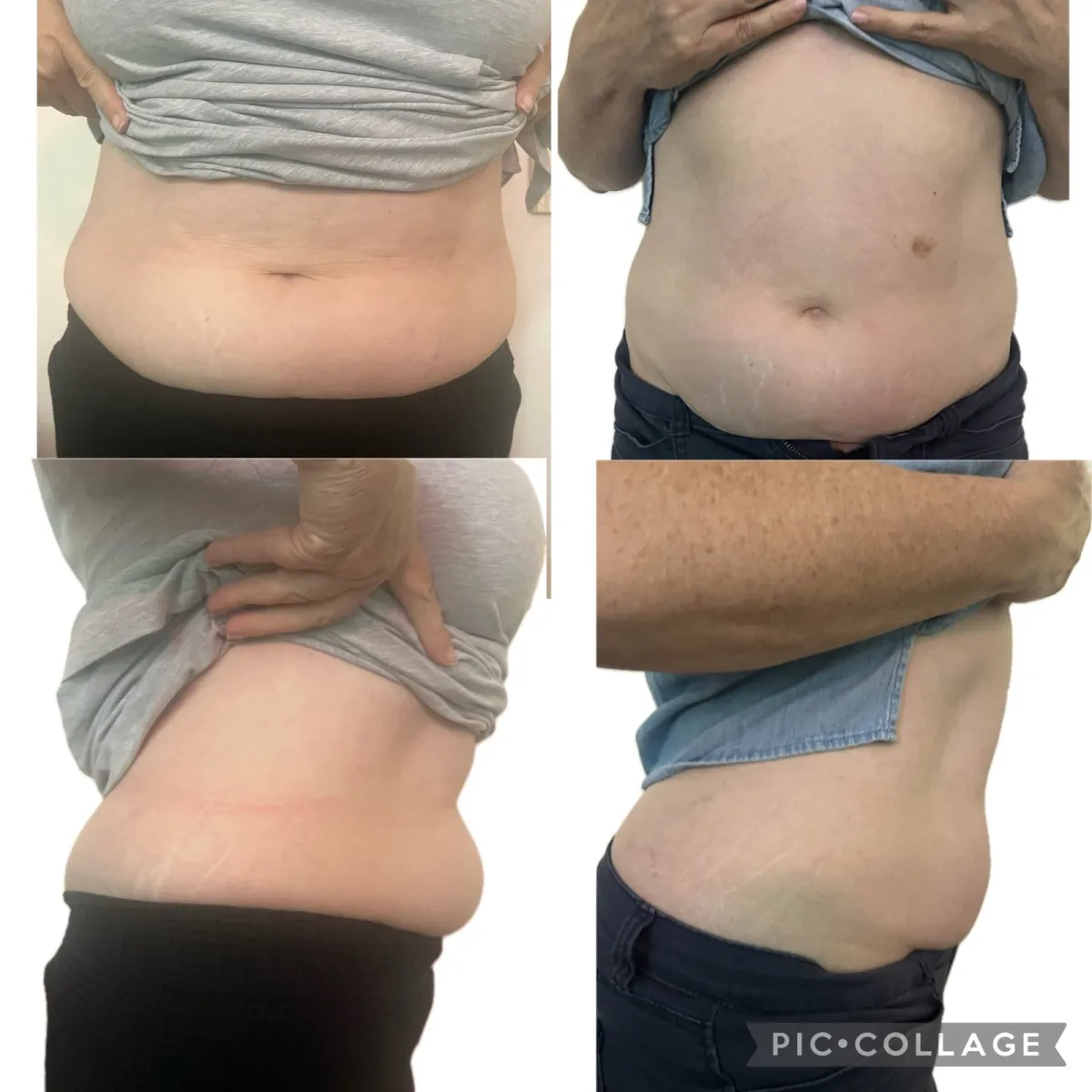 Front and side views of a woman's abdomen before and after treatment