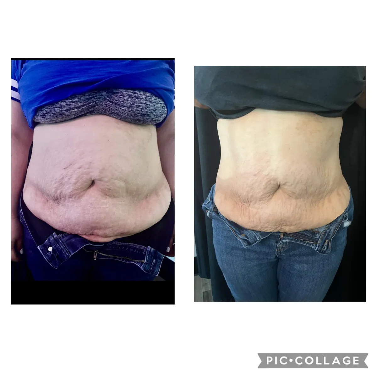 Front view of a woman's abdomen before and after treatment, showing a flatter lower stomach
