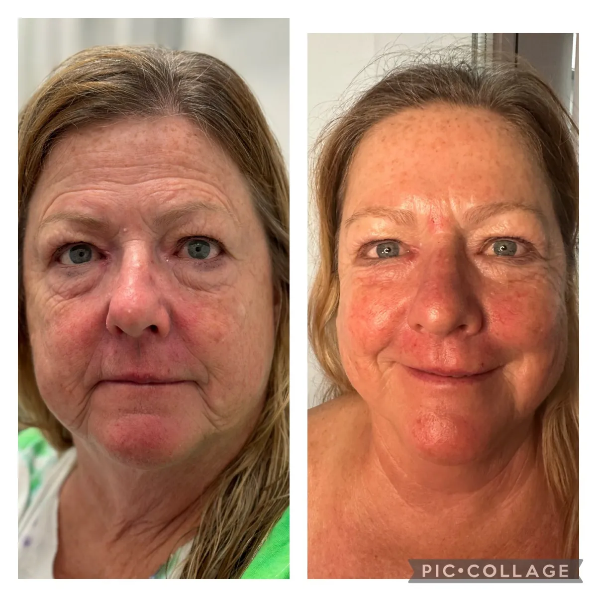 Front view of a woman's face before and after a facial, showing calmer, more even skin