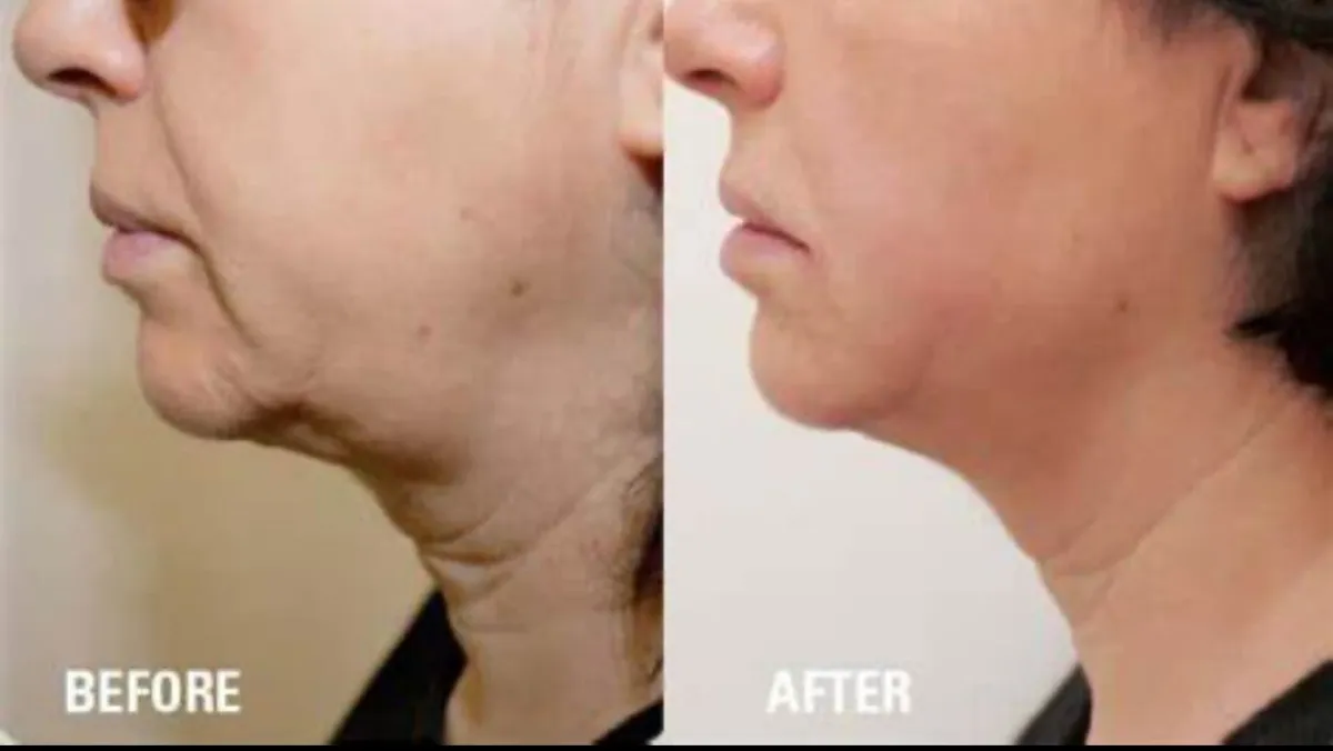 Side profile of a woman's jaw and neck before and after treatment, showing a tighter line under the chin