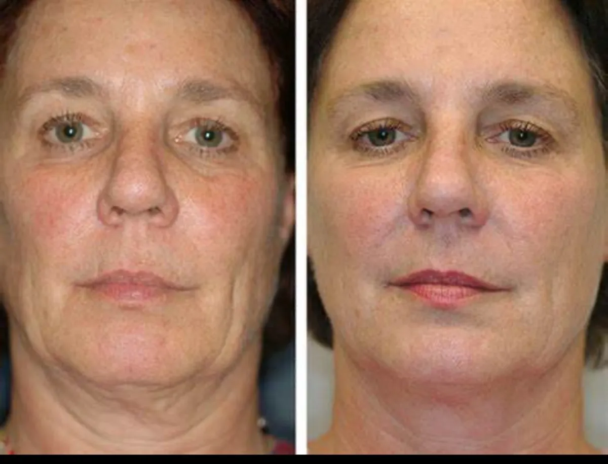 Side-by-side of a woman's face before and after a facial, showing brighter, more even skin