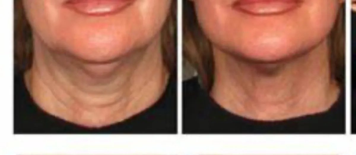 Front view of a woman's neck before and after skin tightening