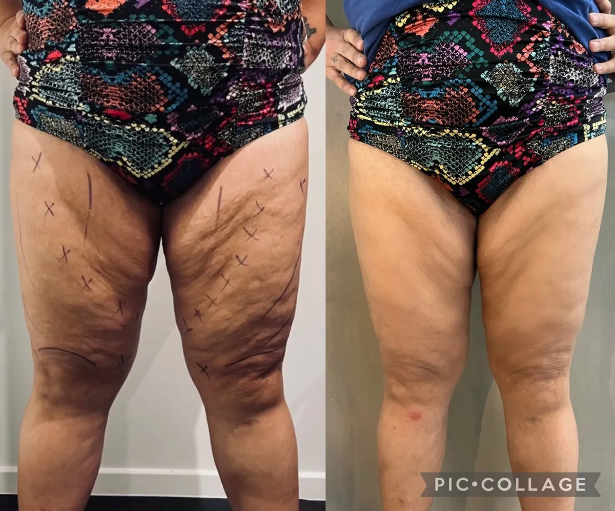 Front view of a woman's thighs before and after treatment, showing smoother skin texture
