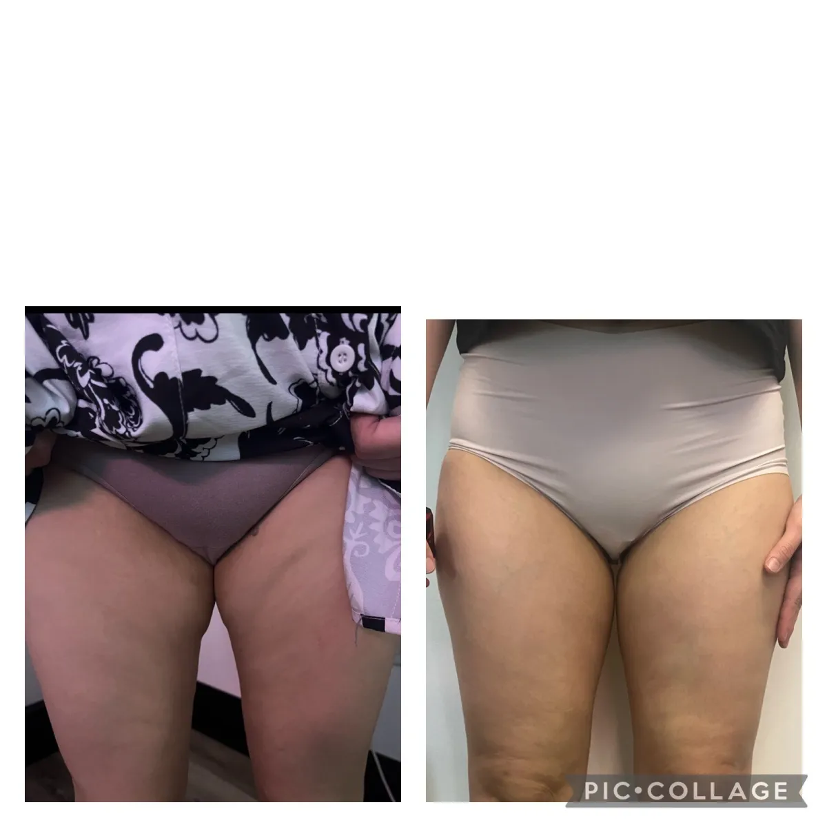 Front view of a woman's thighs before and after treatment